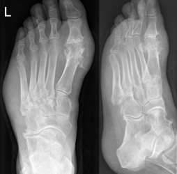 Native Hawaiians are more at risk for gout, study reveals