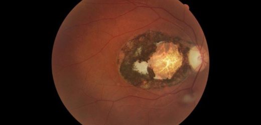 Ocular toxoplasmosis found to be common among Australians