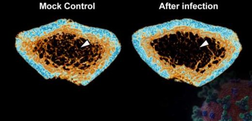 SARS-CoV-2 infection induces severe inflammatory bone loss in Syrian hamsters
