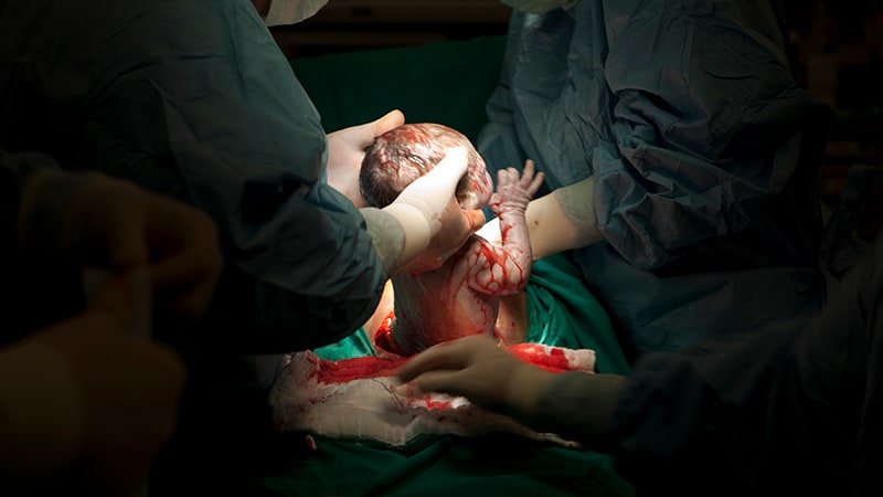 Study: No More Autopilot Opioids After Cesarean Delivery