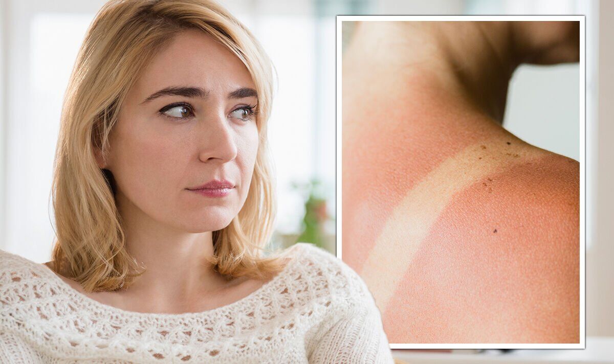 Sunburn: Four ‘important’ ways to treat red and sore skin – medical skin specialist