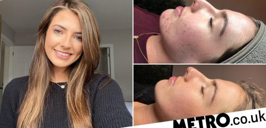 Woman who had severe acne reveals how skincare regime 'changed her life'