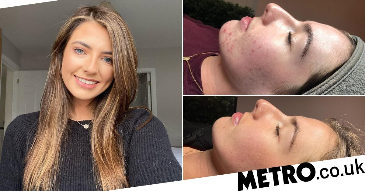 Woman who had severe acne reveals how skincare regime 'changed her life'