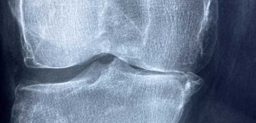 Change in osteoarthritis care needed urgently, NZ health practitioners say