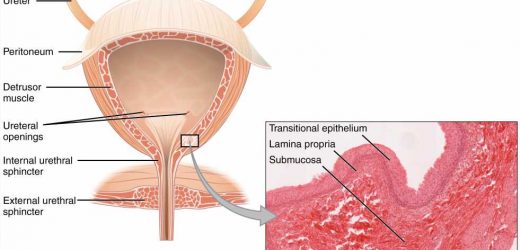 Consumer health: Treating bladder cancer
