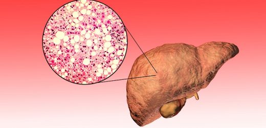 Fatty Liver Disease Drives Rise in Liver Cancer Deaths