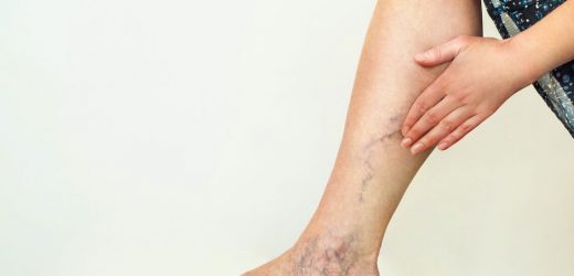Largest-ever study into varicose veins shows need for surgery is linked to genetics