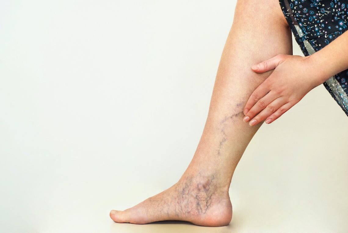 Largest-ever study into varicose veins shows need for surgery is linked to genetics