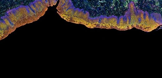 Mice study unravels the role of T. denticola in Alzheimer's disease pathogenesis