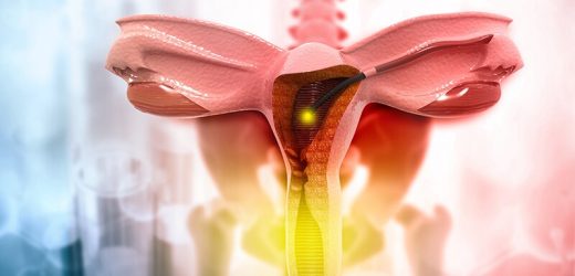 Preneoplastic Lesions Too Often Treated With Hysterectomy