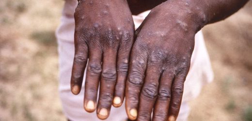 Stern new monkeypox sex warning issued as number of UK cases explode