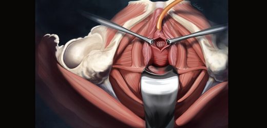 Surgeons May Underestimate Recovery From Incontinence Operation