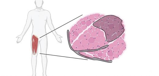 Thigh Muscle Fat Predicts Risk of Developing Heart Failure