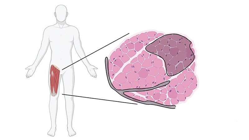 Thigh Muscle Fat Predicts Risk of Developing Heart Failure