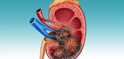 Analysis Shows No Benefit for Cytoreductive Nephrectomy