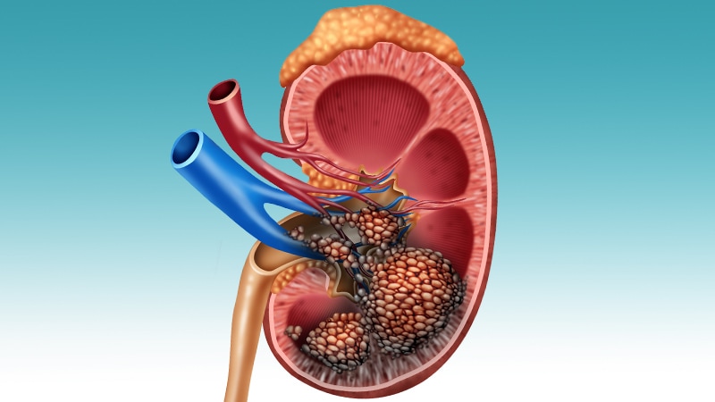 Analysis Shows No Benefit for Cytoreductive Nephrectomy