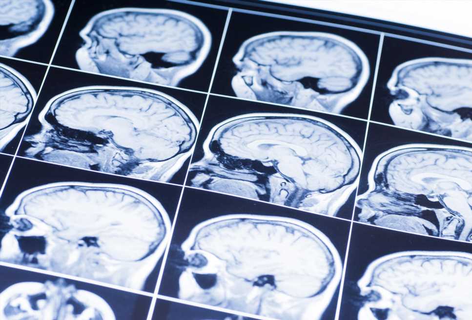 Head injuries in children linked to reduced brain size and learning difficulties