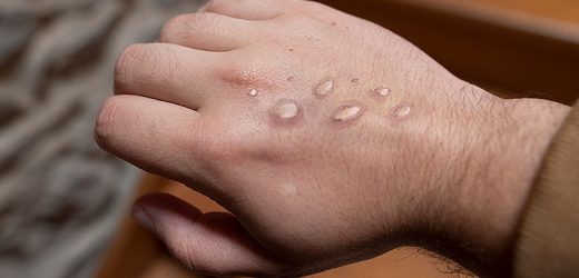 Monkeypox: Large Study Highlights New Symptoms