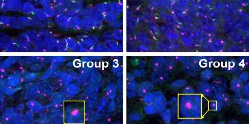 Primary cilia in medulloblastoma: Mechanisms provide treatment opportunity