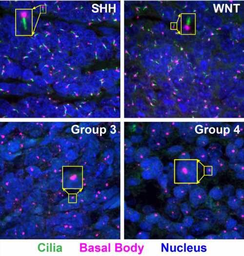 Primary cilia in medulloblastoma: Mechanisms provide treatment opportunity