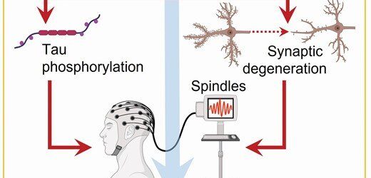 Research finds how brain inflammation may link Alzheimers risk, sleep disturbance