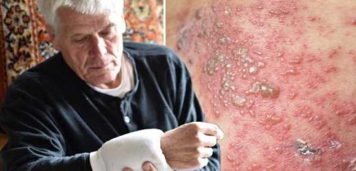 Shingles: The 7 simple self-care tips for easing ‘itchy’ and ‘painful’ skin