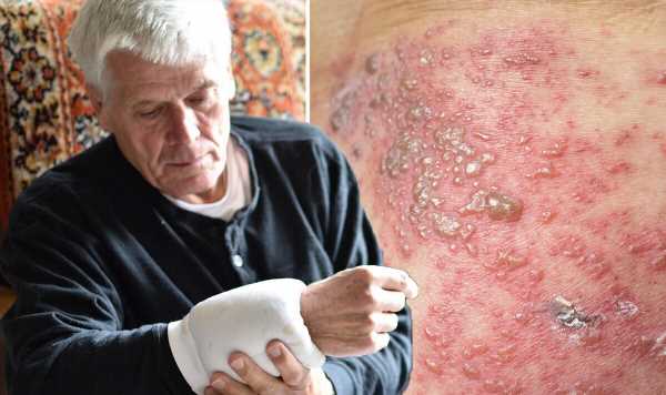 Shingles: The 7 simple self-care tips for easing ‘itchy’ and ‘painful’ skin