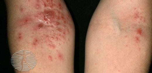 Study Evaluates Disease Burden in Adults With Atopic Dermatitis