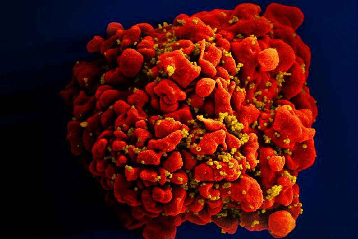 Study shows HIV speeds up body’s aging processes soon after infection