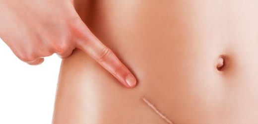 Understanding the genetic testing-related information needs of ovarian cancer patients