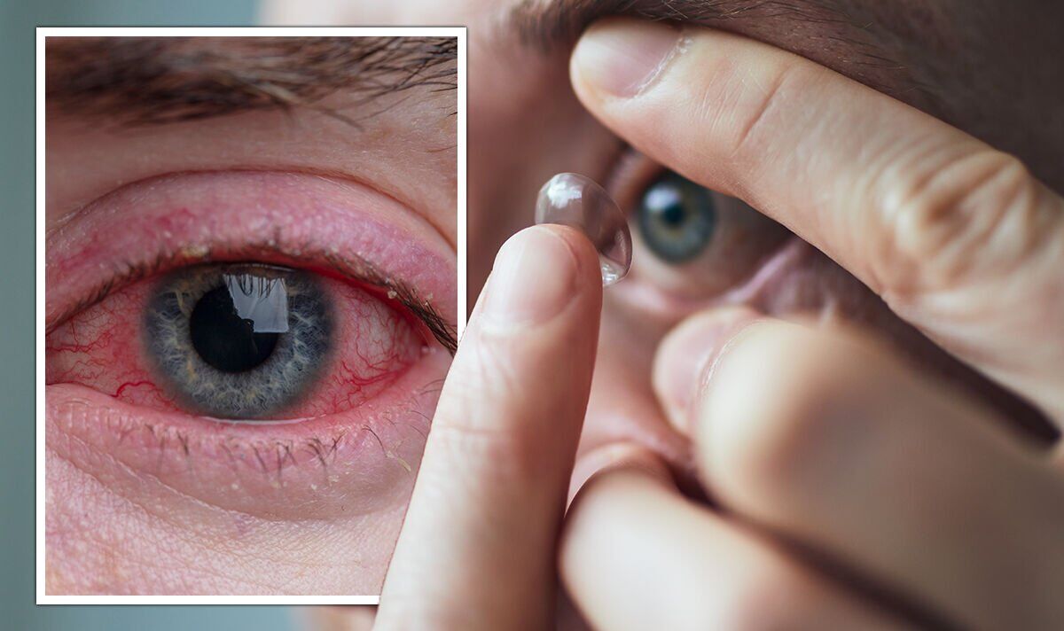 Wearing eye contacts for too long could lead to internal ‘damage’ and vision loss – signs