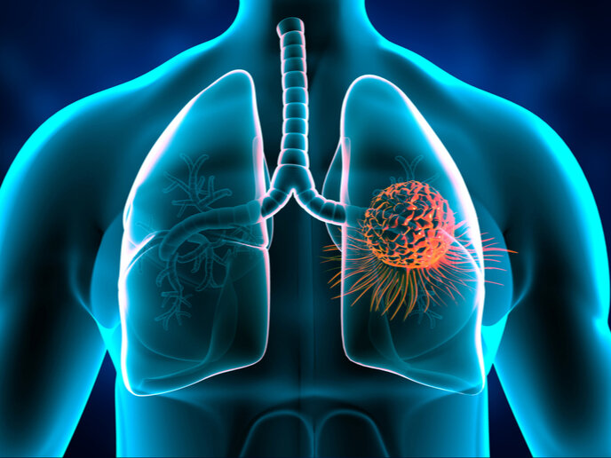 what-happens-when-breast-cancer-spreads-to-the-lungs-patriot-news