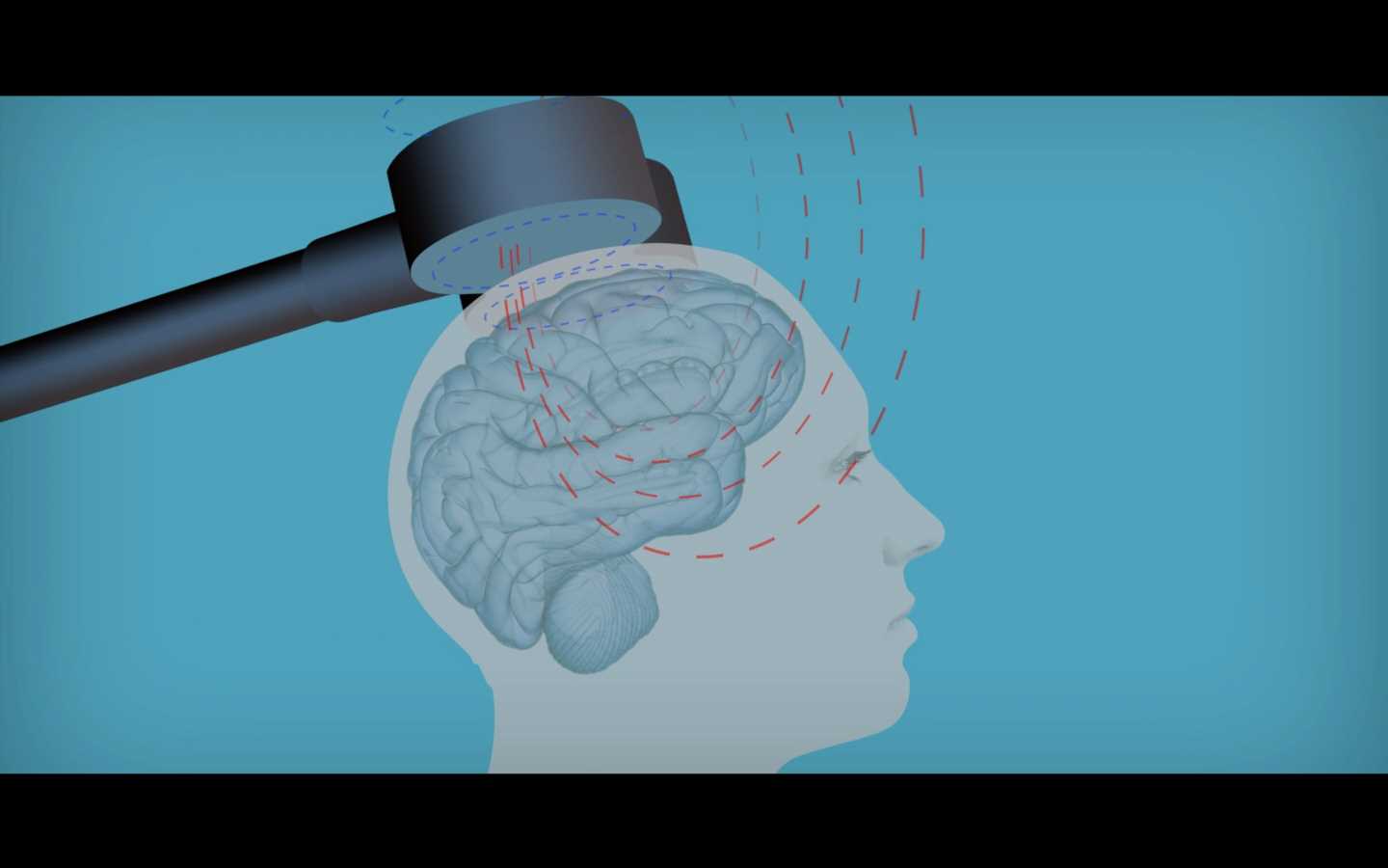 Why brain stimulation should not be overlooked as an antidepressant treatment for older adults