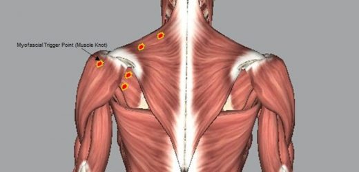 What are muscle knots? An exercise physiologist explains what those tight little lumps are and how to get rid of them