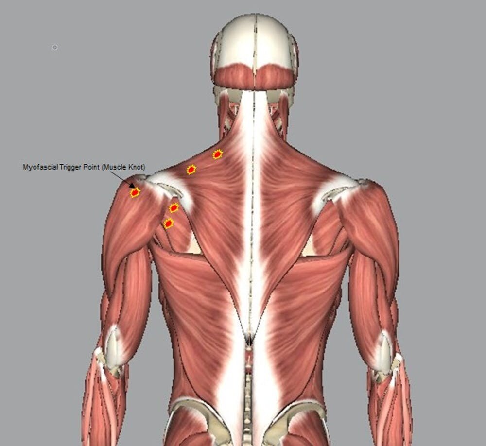 What Are Muscle Knots An Exercise Physiologist Explains What Those