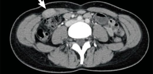 Another Drug Targeting NOTCH Shows Promise for Desmoid Tumors