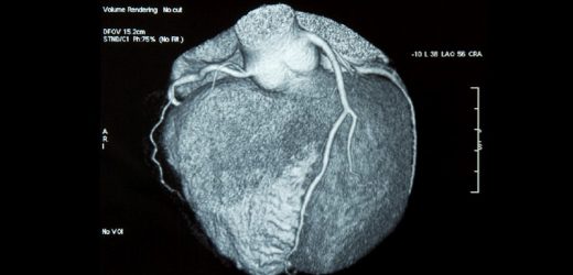Expert Consensus Guides Use of Cardiac CT in Patients With Cancer
