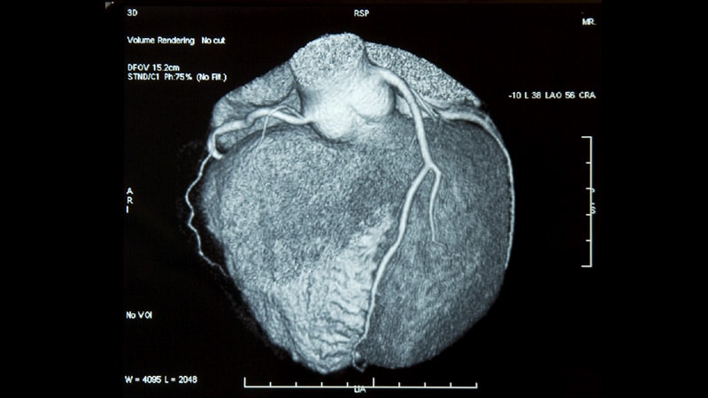 Expert Consensus Guides Use of Cardiac CT in Patients With Cancer