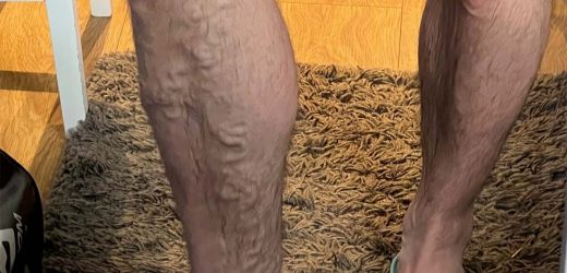 Fit 29 year old ‘surprised’ by ‘bulging’ varicose veins
