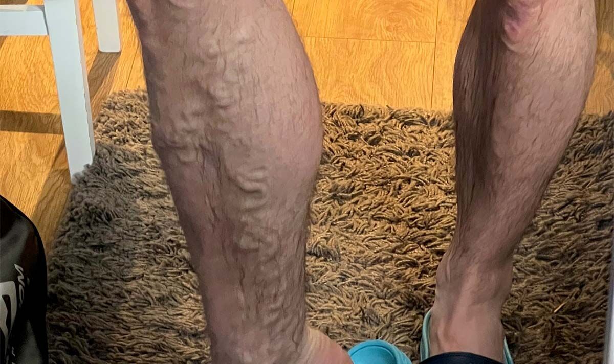 Fit 29 year old ‘surprised’ by ‘bulging’ varicose veins
