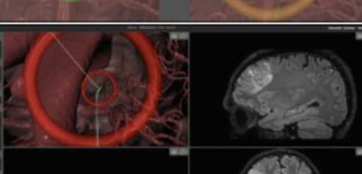 New flexible, steerable device placed in live brains by minimally invasive robot