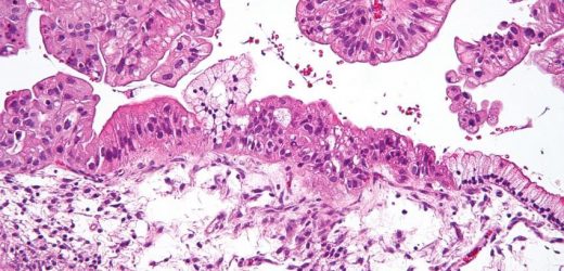 New genetic study reveals why some women get aggressive breast and ovarian cancer