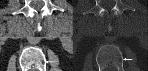 Novel photon-counting CT improves myeloma bone disease detection