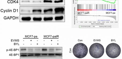Overexpressed Cyclin D1 and CDK4 proteins are responsible for the resistance to CDK4/6 inhibitor in some breast cancer