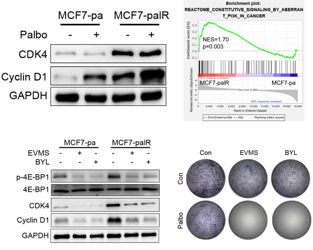 Overexpressed Cyclin D1 and CDK4 proteins are responsible for the resistance to CDK4/6 inhibitor in some breast cancer