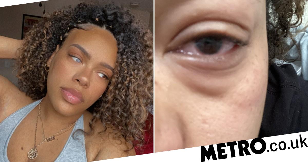 Parasite infects woman's eye after she washed contact lens case in water