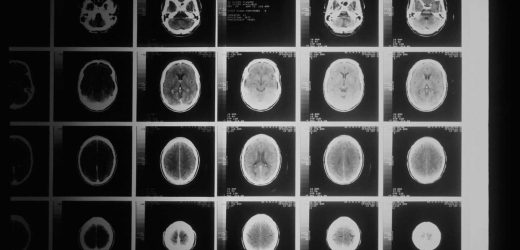 Study pinpoints origin of pediatric brain tumor type and shows it may be preventable