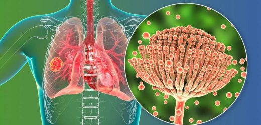 Study presents rare cases of COVID-19-associated pulmonary aspergillosis
