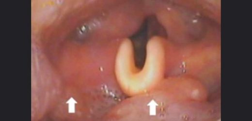 Symptoms Predict Therapy Failure, Death in Oropharyngeal Cancer