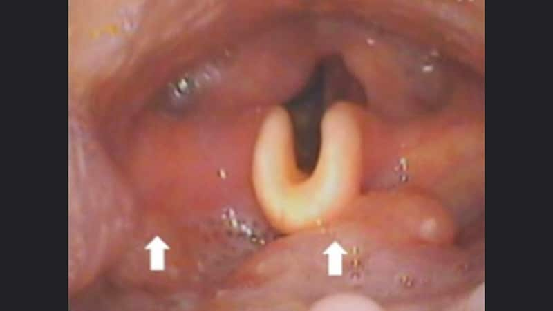 Symptoms Predict Therapy Failure, Death in Oropharyngeal Cancer